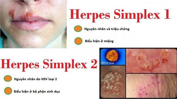 Biểu hiện lâm sàng của bệnh do Herpes simplex